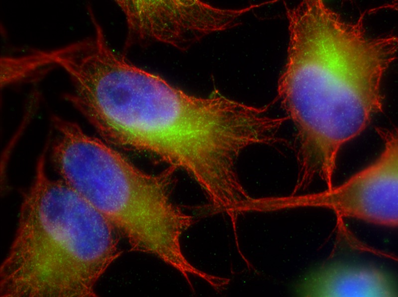 Cancer Cell: A microscopic image of HeLa cancer cells stained with chemical dyes to visualize with internal structures (red and green) and DNA (blue) labeled.